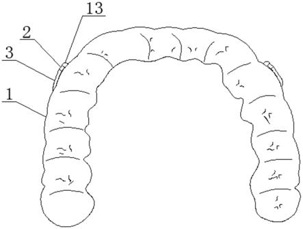 一种压膜式前方牵引口腔矫正装置的制作方法
