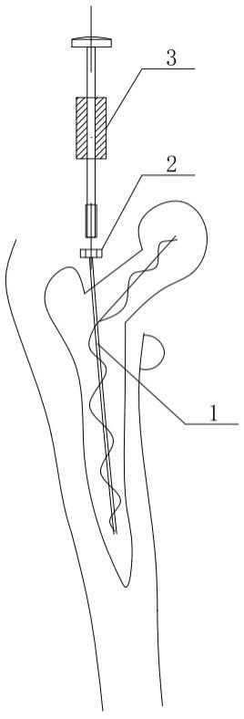 人工髋关节翻修术中骨水泥占位器内支架的制作方法