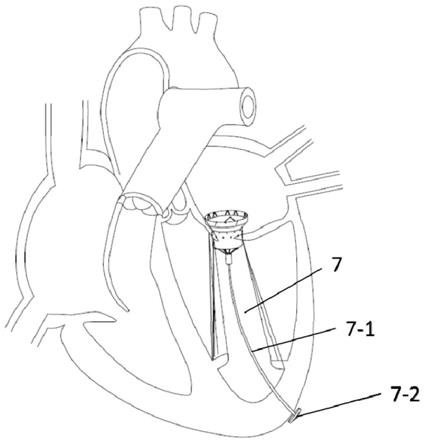 一种介入式人工心脏瓣膜的制作方法