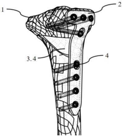 矫形截骨系统的制作方法