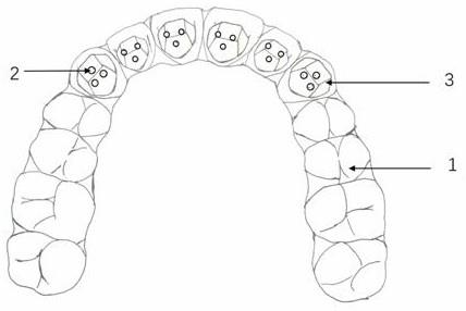 隐形矫治过程中压低前牙升高后牙打开咬合的隐形装置的制作方法