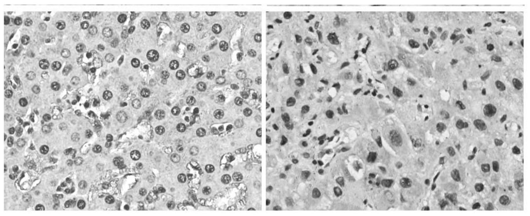 FOXA3蛋白在制备肝癌预后评估及索拉菲尼疗效预测试剂盒中的应用的制作方法