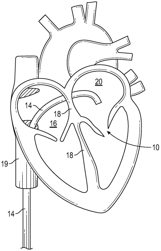 用于微创心脏瓣膜修复的横向螺旋心脏锚固器的制作方法