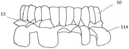 一种适用于全口种植的固位式临时牙的制作方法