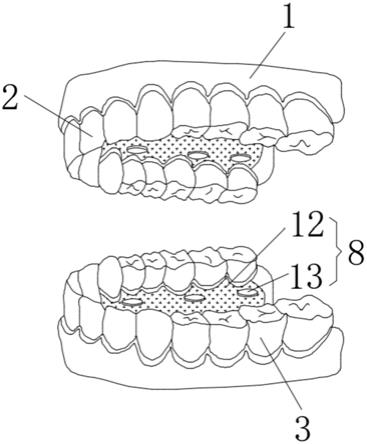一种带有金属连接器的可摘义齿的制作方法