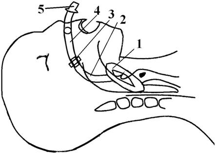 一种可拆卸分体式喉罩的制作方法