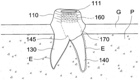 具有可拆卸型牙根的自然牙齿形状的植牙装置的制作方法