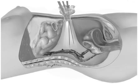 一种经脐单孔腹膜外路径淋巴结切除的方法