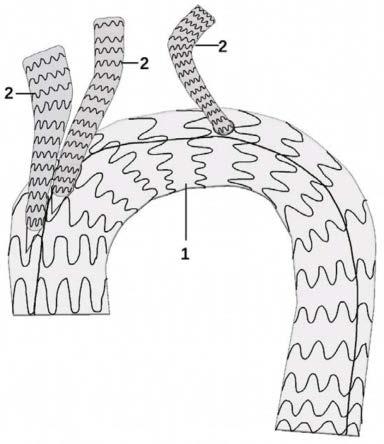 一种主动脉弓分支型覆膜支架的制作方法