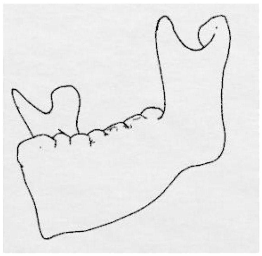 一种精准义齿的设计方法及其义齿与流程