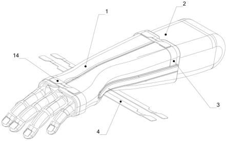 超腕关节夹板及其使用方法与流程
