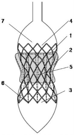 一种具有内收式翼展裙边的球囊扩张式介入瓣膜支架的制作方法