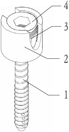 用于骨盆前环固定的可拆卸螺钉及内固定装置的制作方法
