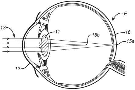 用于视力治疗的消色差镜片的制作方法