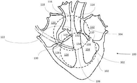 房性心律失常患者的心脏收缩性调节的制作方法