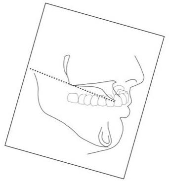 三维牙齿模型与头颅侧位片、单反照片相互配准的方法与流程