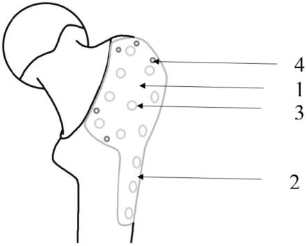 一种股骨大转子处锁定接骨板的制作方法