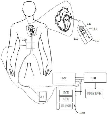 一种心脏壁厚监测装置的制作方法