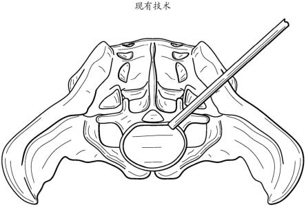 支撑皮质边缘的椎间体装置的制作方法