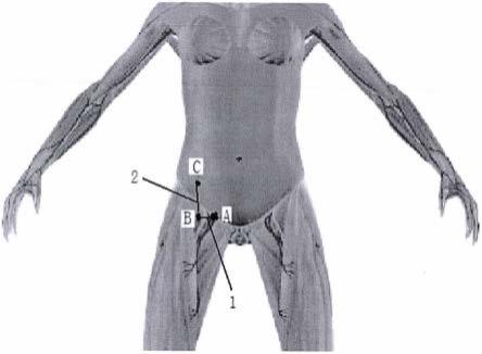 一种腹壁固定式双隧道PICC技术经股静脉置入方法与流程