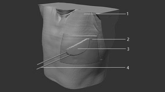 浅表肿瘤近距离放疗联合3D打印治疗方法与流程
