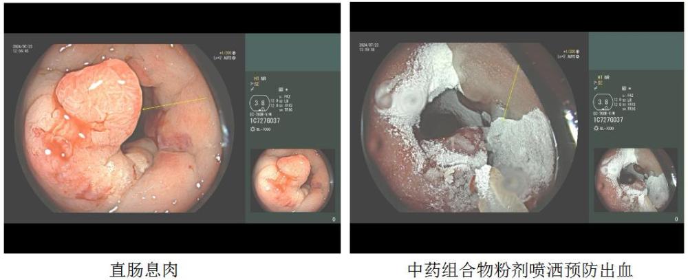 一种用于防治‌消化道粘膜术‌后出血的中药组合物及其制备方法